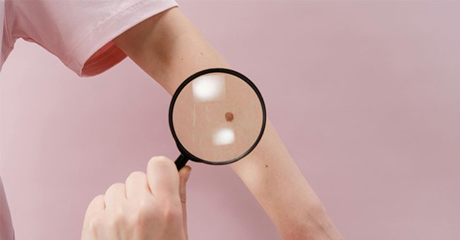 A stock image of a mole being examined.